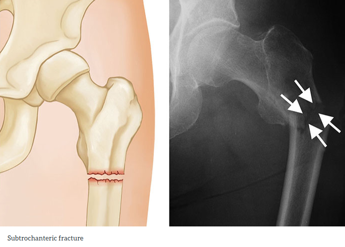 Hip Fractures Spencer Orthopedics